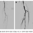 말초혈관질환 바로알고 대처 합시다. 이미지