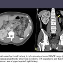 4 Hypoplastic non-functional kidney 이미지