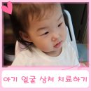 안양삼성어린이집 | 19개월 아기 얼굴 상처 치료하기 (+ 안양 삼성올바른외과 방문 후기)