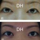 뒷트임복원, 쌍커풀재수술, 애교살지방이식 진솔리얼후기 두한성형외과