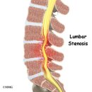 척추 전방 전위증(spondylolisthesis) 이미지