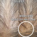 장곡아래 | 시흥 장곡,능곡,군자 중년남성탈모 모발생장술후 두피문신