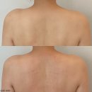 웰스코리아 | 상체(어깨, 목, 팔, 승모근) 교정 관리. 압구정 에스테틱 ‘웰스파’ 액와마사지 후기