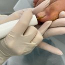 클린풋네일 & 베어푸스플레게 무좀발톱 내성발톱 발각질 | [대구 무좀발톱] 19년 경력 문제성 손발톱전문가가 케어해주는 ‘클린 풋 네일 내당점‘