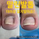 와이제이커뮤니케이션 | <오류동 내성발톱> 파고들고 잘라내고 무한 반복의 굴레에서 벗어나다!