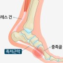 족저근막염, 발바닥 통증이 있으신분은 필독해주세요 이미지