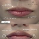 예산미소천사의원 | 홍대 입술필러 잘하는 곳 후기 부작용 총정리