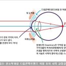 봄의약속안과] 우리 아이 근시 떄문에 걱정이라면...? 드림렌즈로 라식 효과를!!!????(강동구 드림렌즈,드림렌즈 효과) 이미지