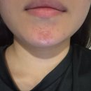 드림21피부과의원 | 창원 여드름 피부과 치료 내돈내산 후기, 5일 변화 기록ㅣ턱 모낭염 압출, 가격, 약 처방