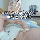 소아솝 | 아기 수족구 증상과 전염 원인 예방법 총정리