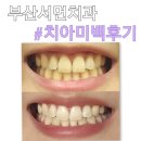 부산서면치과 치아미백 1회차 후기