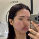 정원의원 | 신사역 피부과 추천 | 예피다의원 -강남 쥬브아셀 시술 후기, 모공·피부결 고민 해결 신사 피부과 솔직...
