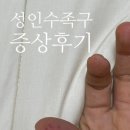 구인약국 | 성인 수족구 어느 병원에가야할까? 증상 후기 아이들만 걸리는게 아니에요