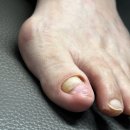 엔피(NP)케어 울산중구점 | 울산 남구 발톱무좀 깨끗한 발을 갖고 싶다면