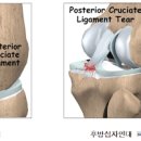 오금 통증 원인 5가지 치료 방법 스트레칭 : 무릎 뒤쪽 통증 이미지