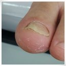 숭의역 | 인천 숭의역 제물포역 무좀발톱 관리로 단번에 좋아졌어요 에이풋케어 내성발톱 발톱무좀 발각질 문제성발