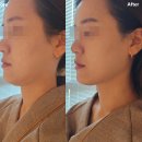 차올 | 천안 피부관리 청당동 "차올 에스테틱" 4D쎄라 미니V컷 관리 후기
