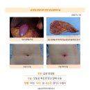 급성담낭염수술후기. 최근에 잦은 명치통증과 우측상복부통증이 잦아져 밥을 꼬박 새는 날이 많아졌어요. 이미지