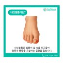 한영정형외과의원 | 수원 팔달구 화서동 파고드는 내성발톱 남녀노소 교정기치료 가능한 곳은
