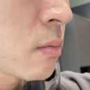 삼성의원 | 삼성 밴스의원에서 젠틀맥스프로플러스 받아본 후기