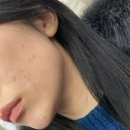 수원 문제성 피부 트러블 관리 효과본 수원역 바라에스테틱 내돈내산 후기(30회 넘게 결제한..)