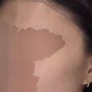 현대한의원 | 가산 한의원 추천 여드름 흉터치료 새살침 효과 내돈내산 후기