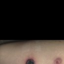 t세포림프종(SPTCL OR nasal NK/T) 이미지