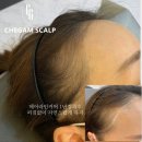 스켈피아 | 영등포탈모관리 M자 헤어라인 커버 완벽 커버