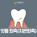 더이룸치과의원 | 신길역치과추천, 잇몸 퇴축(치은퇴축), 자연 회복이 어려운 이유