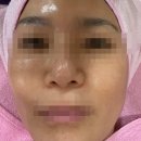 권내과의원 | 노원구 기미레이저 주근깨 잡티 관리하기