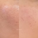 신생한의원 | 강남역 여드름한의원 새살침 미라젯 후기 여드름 패인흉터 효과 전후 비교