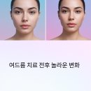 후 | 여드름 치료 전 후 사진/후기