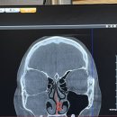 연세고른숨이비인후과의원 | 비염수술 후기 비중격만곡증,하비갑개점막하, 부비동내시경(연세고른숨이비인후과)