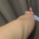 [삼성 라마르의원] 팔뚝 지방흡입 후기/심각한부작용/