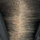 LUAR | 부산 탈모 두피커버 후기! 결혼 앞두고 루아르에서 자신감 되찾았어요!