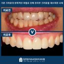 심미연합치과의원 | 마산합포구치과잘하는곳, 타치과에서 반복적으로 깨지는앞니 크라운을 튼튼하게 만드는!