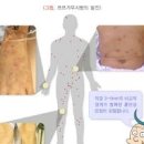 봄철 조심해야하는 살인진드기(SFTS)와 쯔쯔가무시병 이미지