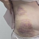 멍꼬미 | 러브핸들빼는법 러브핸들주사 당일 후기(멍 통증 효과)