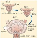 전립선 비대증 이미지