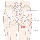 [고관절] 고관절 인공관절수술 이미지