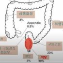 직장암 초기 증상 원인 치료 직장암 1기 2기 3기 4기 생존율 이미지