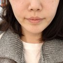 림피부과의원 | 판교피부과 얼굴지방분해주사 후기 – 밴스의원에서 시술받은 솔직 리뷰