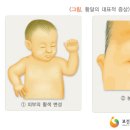 신생아황달[neonatal jaundice , 新生兒黃疸] 이미지