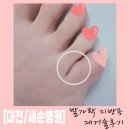 새손병원 | 대전 새손병원 입원 발가락 지방종 제거술 후기