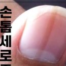 엄지손톱검은세로줄 흑색종 손톱에 가로줄 뭘까? 이미지