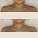 꼬미에스테틱 하남미사점 | 하남미사 웨딩관리 솔직 후기 꼬미에스테틱 제니 직각어깨 효과