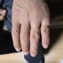 실로 | 실로바이오닉 의수 제작 후기, 의수 비용