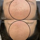 어나더 핸드 | 논현역 피부관리 퓨어플라즈마 여드름관리 후기 | 어나더핸드 에스테틱 강남논현점