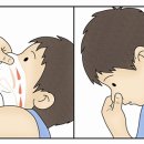 비출혈[epistaxis] 이미지