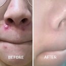 (주)한코교역 | 코옆 붉은기&amp;코주변 뾰루지 여드름 완벽히 없앤 후기